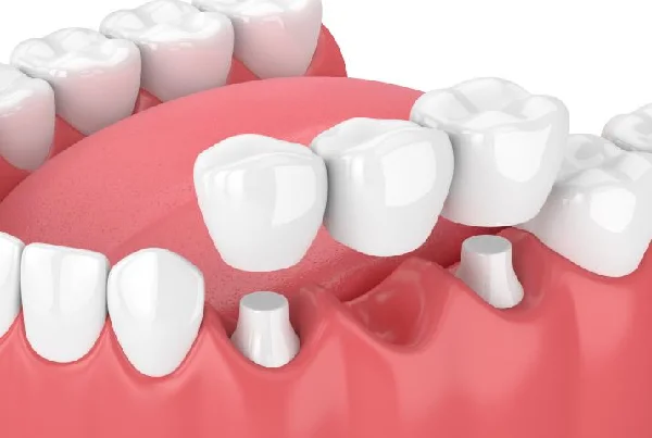 DENTAL CROWNS  BRIDGES