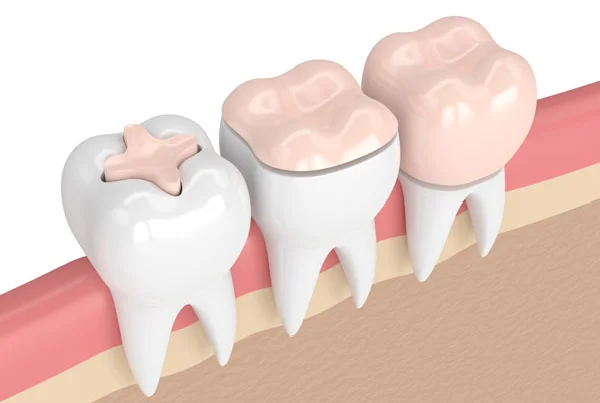 Restorations